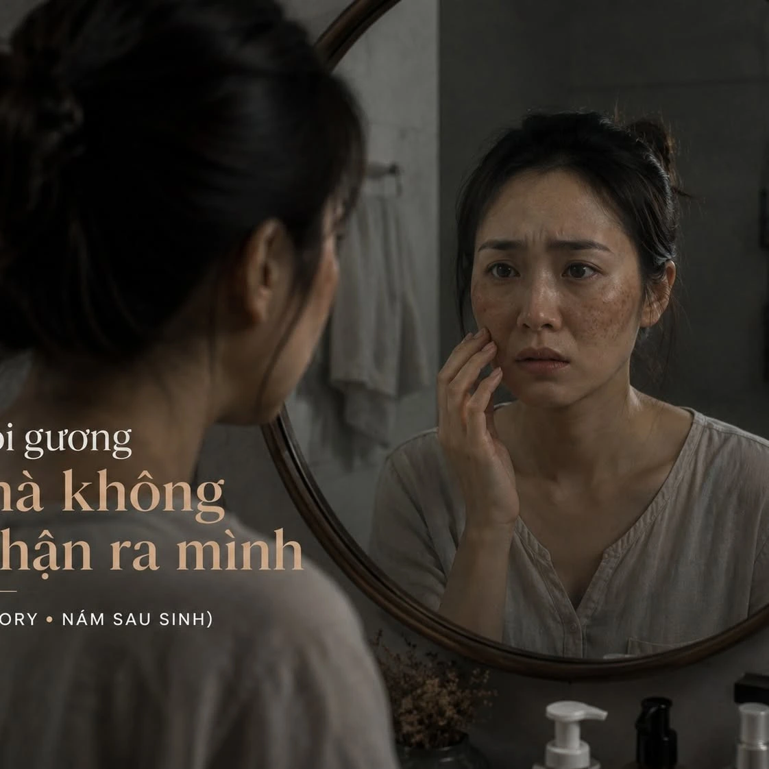 Nám sau sinh tại phòng khám da liễu Kim DMP Gò Vấp