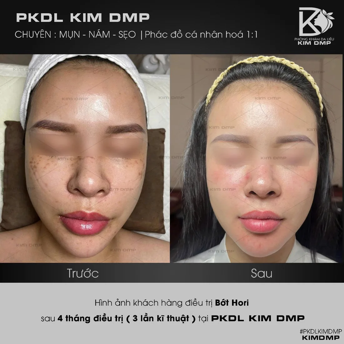 Hình ảnh trước và sau khi chăm sóc bớt hori tại Kim DMP Gò Vấp