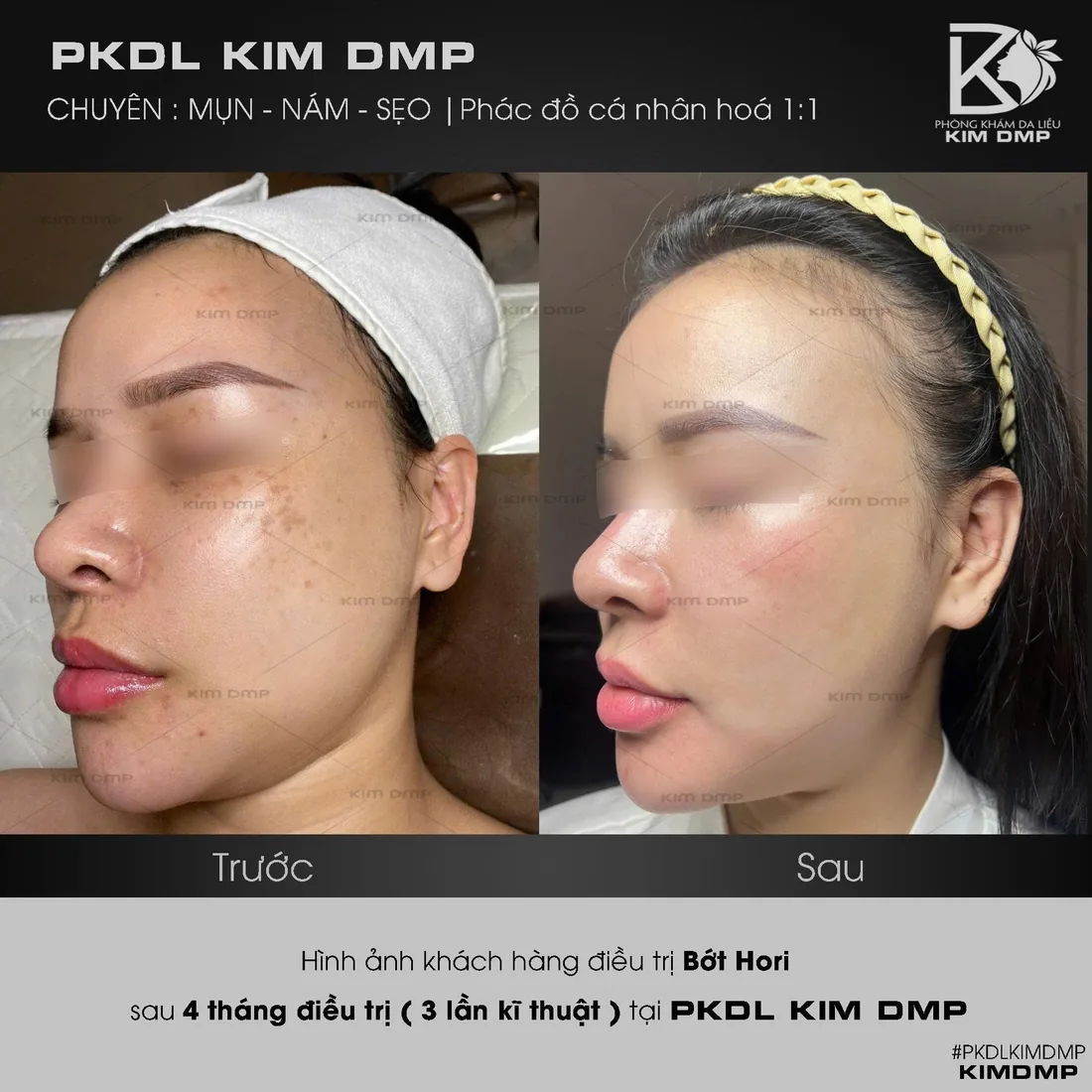 Hình ảnh trước và sau khi chăm sóc bớt hori tại phòng khám da liễu Kim DMP Gò Vấp