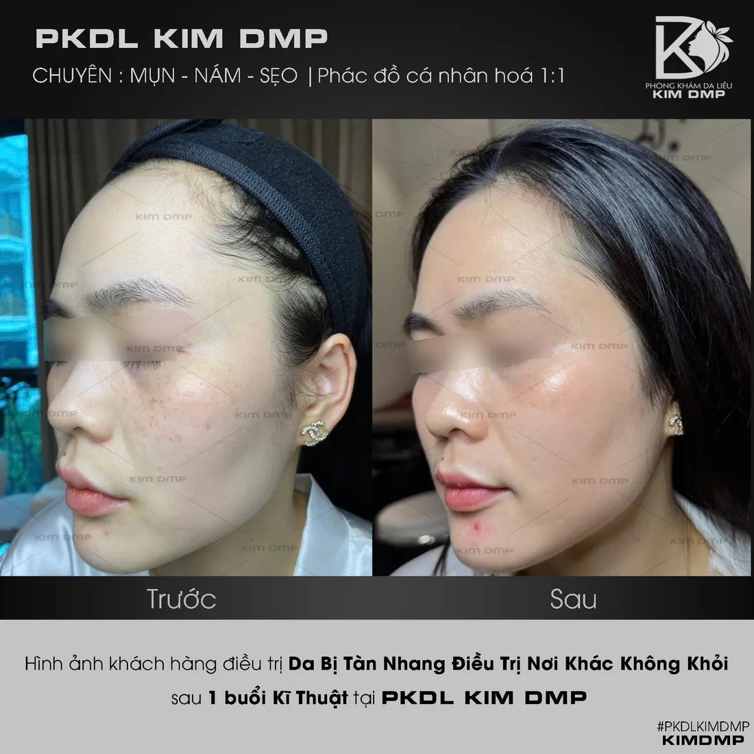 Hình ảnh trước và sau khi chăm sóc tàn nhang đã làm nơi khác nhưng chưa cải thiện tại phòng khám da liễu Kim DMP Gò Vấp