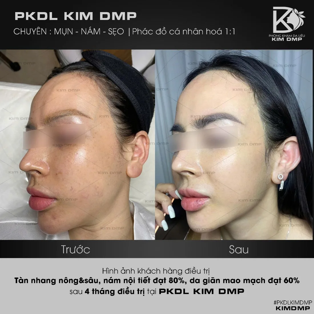 Hình ảnh trước và sau khi chăm sóc tàn nhang nông và sâu, nám nội tiết, da giãn mao mạch tại phòng khám da liễu Kim DMP Gò Vấp