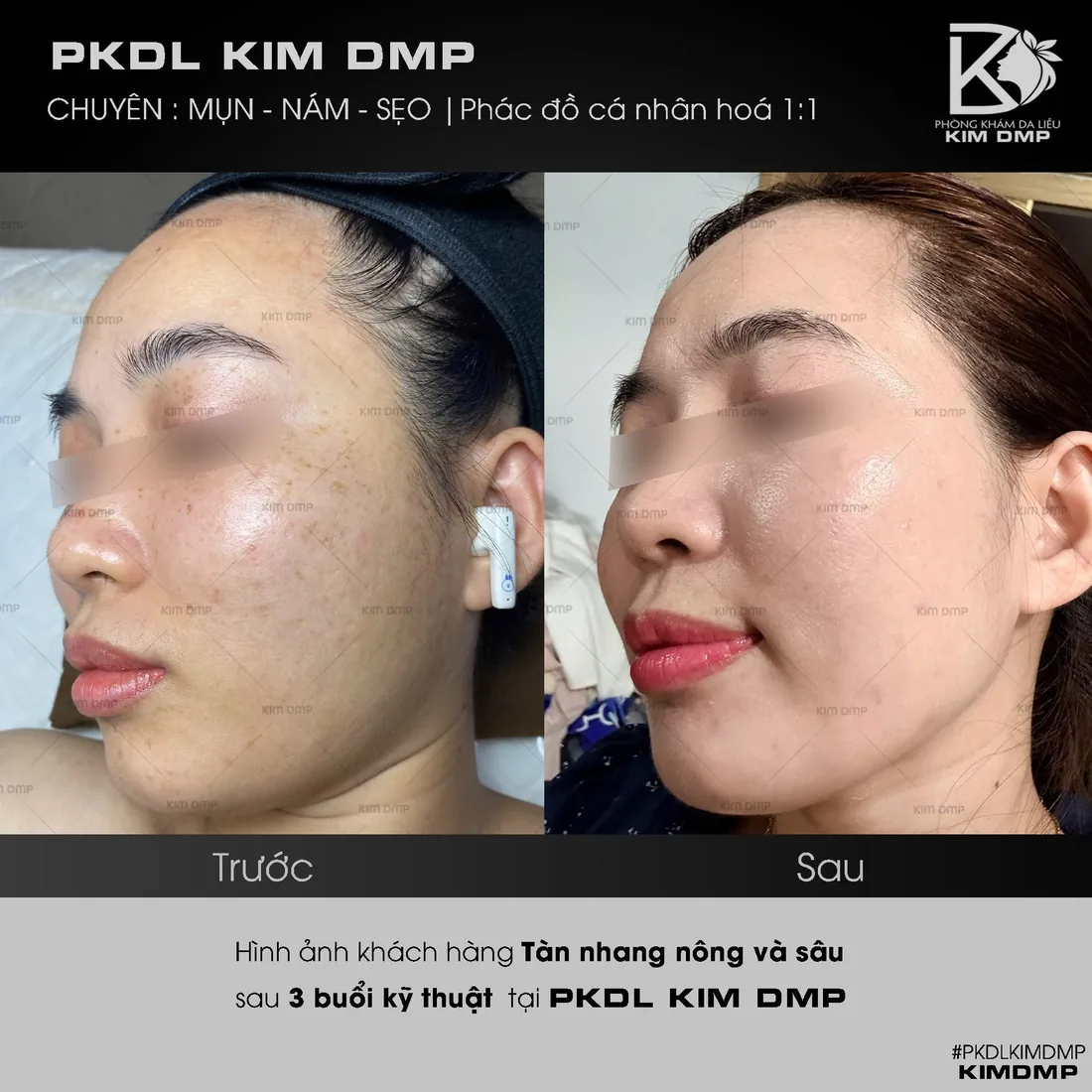 Hình ảnh trước và sau khi chăm sóc tàn nhang nông và sâu tại phòng khám da liễu Kim DMP Gò Vấp