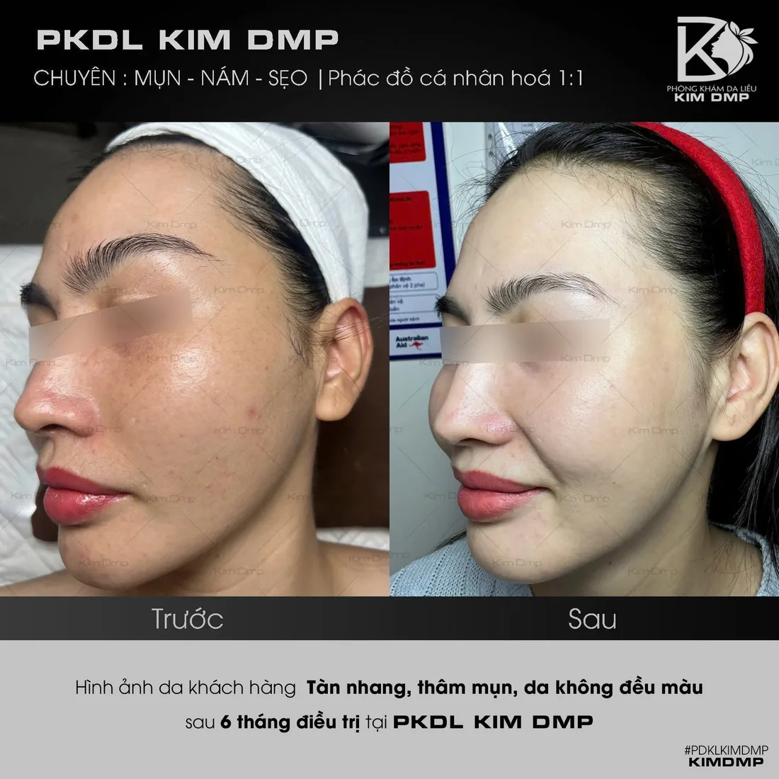 Hình ảnh trước và sau khi chăm sóc tàn nhang, thâm mụn và da không đều màu tại phòng khám da liễu Kim DMP Gò Vấp