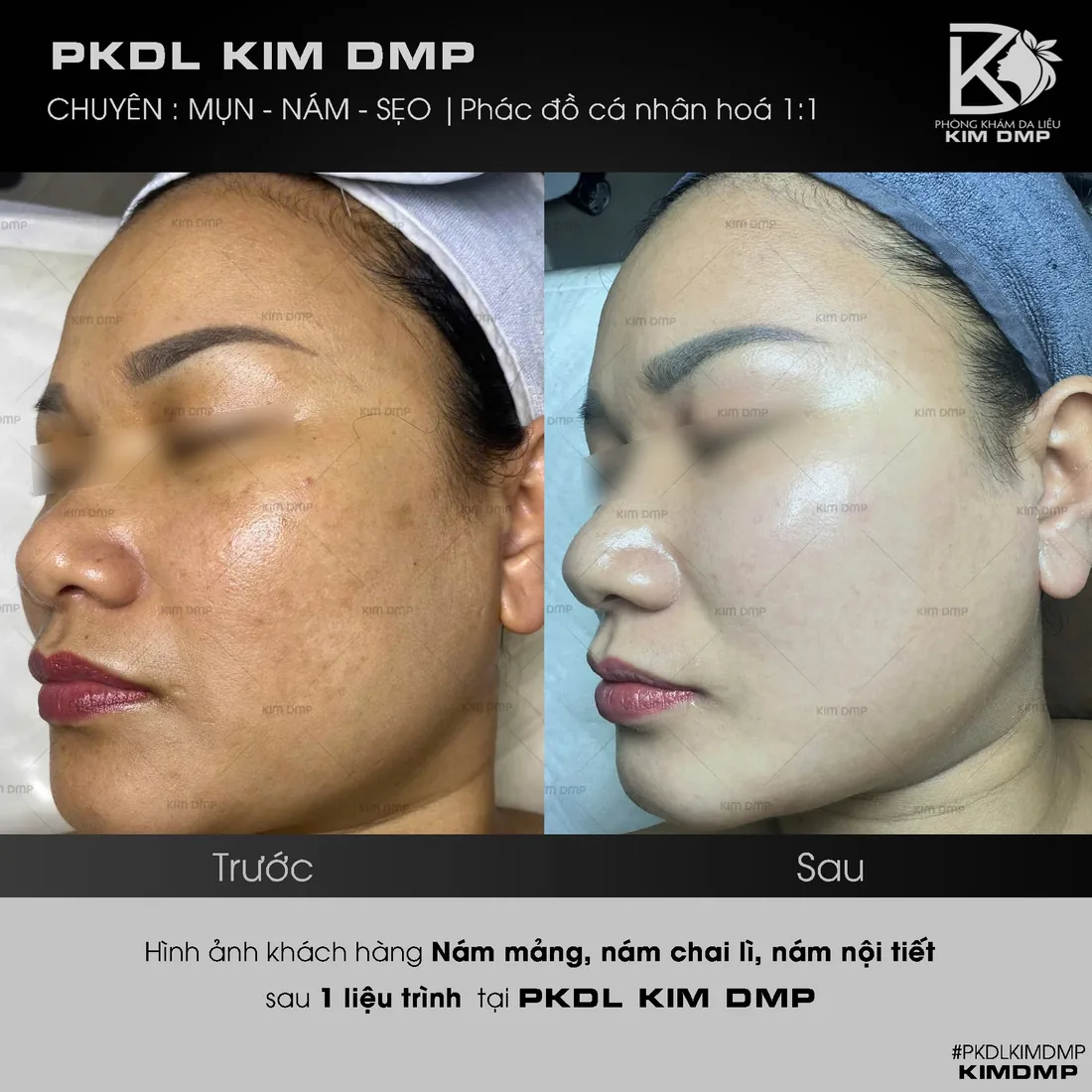 Hình ảnh trước và sau khi chăm sóc nám mảng, nám chai lì và nám nội tiết tại phòng khám da liễu Kim DMP Gò Vấp