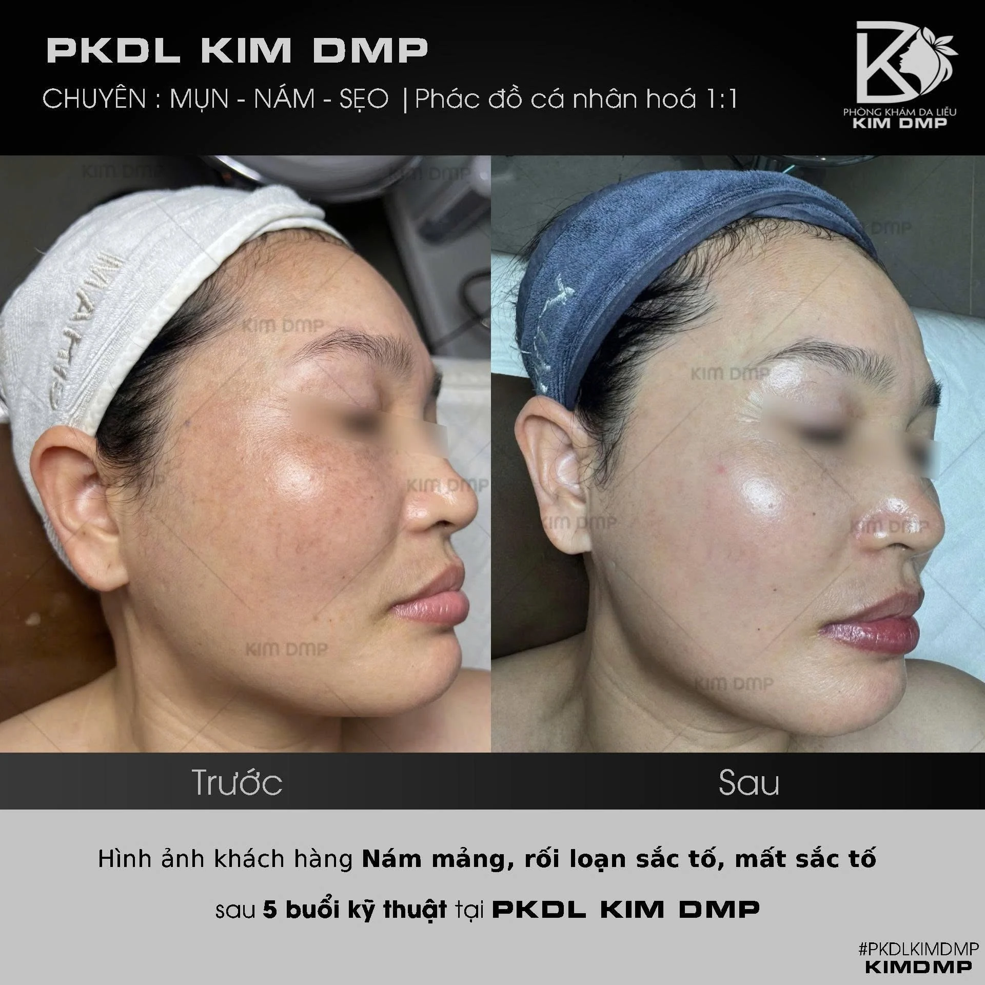 Hình ảnh trước và sau khi chăm sóc nám mảng, rối loạn sắc tố và mất sắc tố tại phòng khám da liễu Kim DMP Gò Vấp